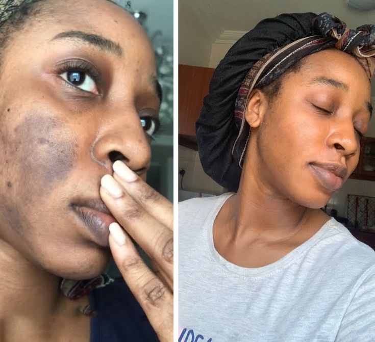 Masque de nuit au curcuma et à l’acide kojique