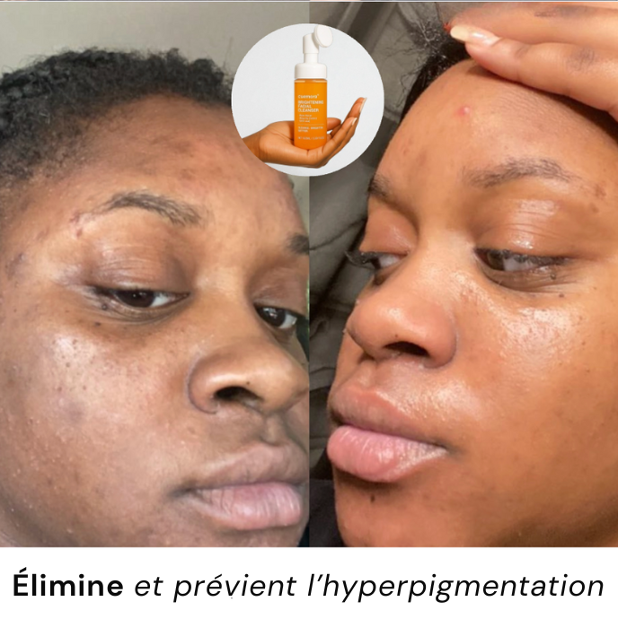 Nettoyant pour le visage à l'acide kojique et au curcuma