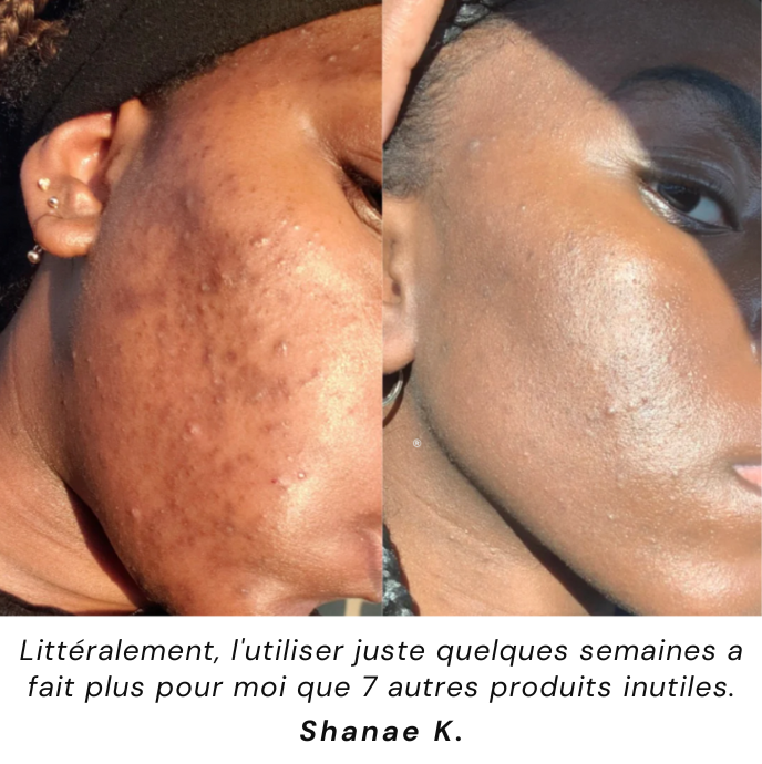 Nettoyant pour le visage à l'acide kojique et au curcuma